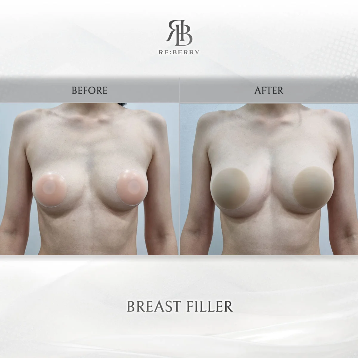 Breast Filler Before After