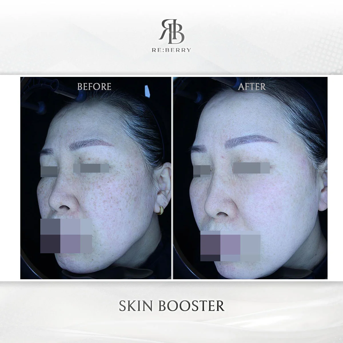 Skin Booster